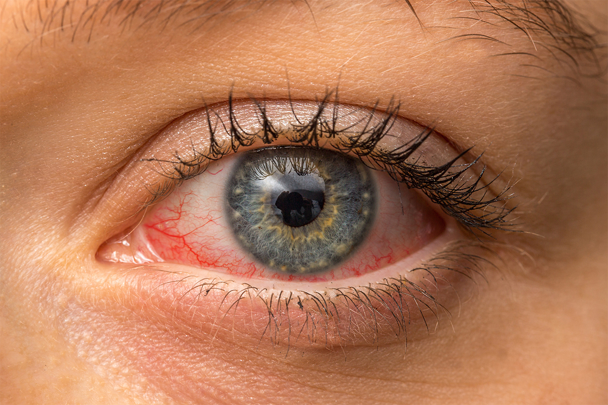 Ochii roșii – ce de sănătate pot indica? - Blog de optică medicală | Lensa.ro